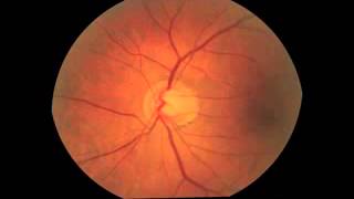 Agreement of Flicker Chronoscopy for Structural Glaucomatous Progression Detection and Factors Assoc [upl. by Anerom]