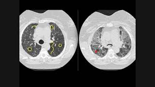 Hypersensitivity pneumonitis how to recognise on chest CT scans [upl. by Reteip]