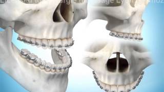 Chirurgie orthognatique ostéotomie maxillaire [upl. by Setiram]