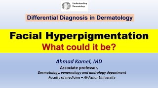 Facial hyperpigmentation What could it be [upl. by Ahsienat]