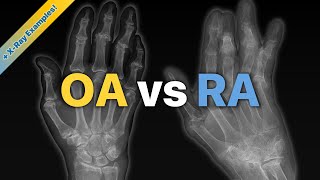 Osteoarthritis OA vs Rheumatoid Arthritis RA Explained  XRay Examples [upl. by Aluk]