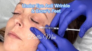 Crows Feet amp Under Eye Jelly Roll Anti Wrinkle Botox  Before During amp After [upl. by Mouldon166]