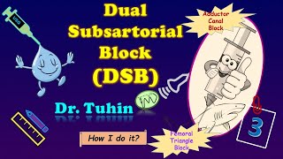 Dual Subsartorial Block  DSB Adductor Canal Block  Femoral Triangle Block  Ultrasound [upl. by Riggins]