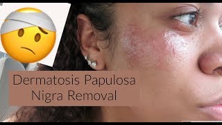 I had my dermatosis papulosa nigra removed [upl. by Fogel]