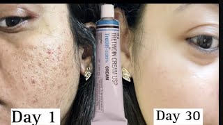 Tretinoin के साथ कौनसे Products Use करे WHAT PRODUCTS TO USE WITH TRETINOIN [upl. by Nossila]