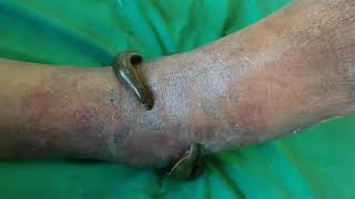 Leech Therapy in Palmoplantar Psoriasis by Dr Bijendra Shah [upl. by Acinahs]