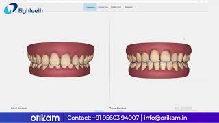 HELIOS 500 Orthodontics Simulation [upl. by Levona]