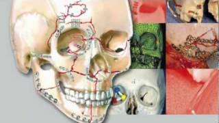 Craniomaxillofacial Buttresses Anatomy and Operative Repair [upl. by Ursal]