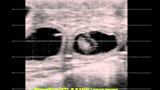 38 day pregnancy test with ReproScan XTL 65 MHz linear probe [upl. by Nanda]