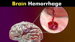 What Happens in Brain Hemorrhage  Symptoms Causes and Treatment UrduHindi [upl. by Kcirrek]