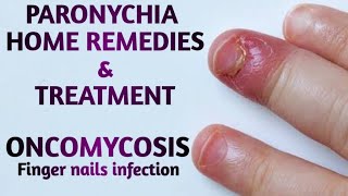 Paronychia Home remedies  Finger nail infection  skin infections  paronychia  finger infection [upl. by Bentley]