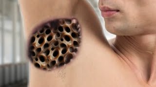 ASMR Perawatan Ketiak Dongla  ASMR Remove Gandul Maggots from Armpit [upl. by Nyrroc787]