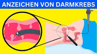 7 Warnzeichen von Darmkrebs Was Sie wissen müssen [upl. by Linnie]