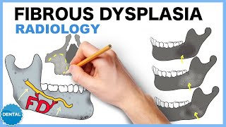 Fibrous dysplasia Radiology [upl. by Bonnes]