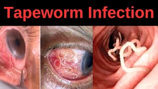 Tapeworm Infection Signs Symptoms Complications [upl. by Alliscirp]