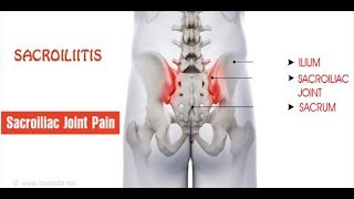 सैक्रोइलिइटिस  Sacroiliitis PAIN  कारण लक्षण और निदान एवं लाभदायक योग [upl. by Kindig]