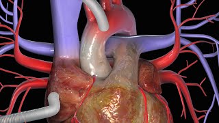 Heart Bypass Surgery CABG [upl. by Mathe]