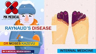 Raynauds disease [upl. by Cutlip187]