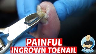 EXTREME PAINFUL INGROWN TOENAIL REMOVALDID IT HURT TO REMOVE IT [upl. by Frodi738]