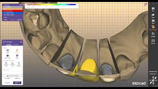 exocad DESIGN DENTALA REDUCED BRIDGE DESIGN FOR EXOCAD 28 [upl. by Ahcropal]