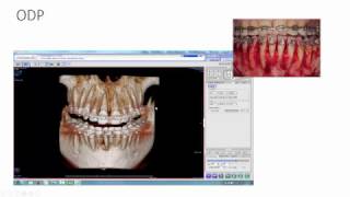 Orthodontic Dehiscence Pattern ODP [upl. by Esilehs]