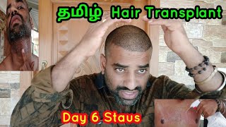 6th day Hair Transplant Update in TamilHSN Hair Transplant in Coimbatore [upl. by Sibel]