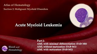 Acute Myeloid Leukemia AML  Part 2 [upl. by Oos]