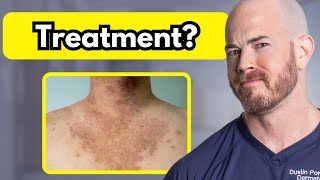 How to Treat Tinea Versicolor  Dr Dustin Portela [upl. by Petronilla345]