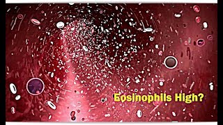 Eosinophils High Low – Causes [upl. by Diann]