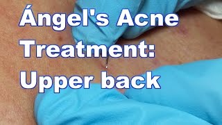 Ángels Acne Treatment Upper Back [upl. by Lyrradal925]