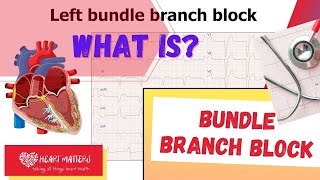 What is a bundle branch block and is it serious [upl. by Ihsorih]