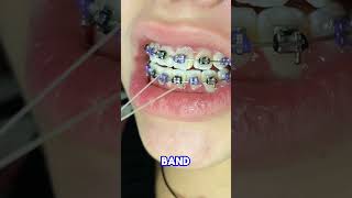 Rubber bands in braces  Toothtime Family Dentistry New Braunfels  Orthodontic Treatment 107 [upl. by Ruelle]