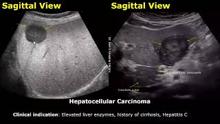 Liver Ultrasound Reporting  Liver Diseases Scan Reports  How To Write USG Report  Abdominal USG [upl. by Ecyor]