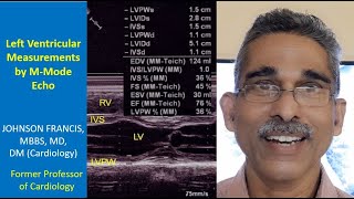 Left Ventricular Measurements by MMode Echo [upl. by Trista]