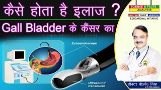 कैसे होता है इलाज GALL BLADDER के कैंसर का  GALL BLADDER CANCER TREATMENT [upl. by Notwen]