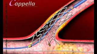 Stent insertion [upl. by Nosna728]