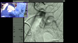 Transradial Embolization of a Splenic Artery Aneurysm  Part 2 Embolization  10 min cut [upl. by Reckford]