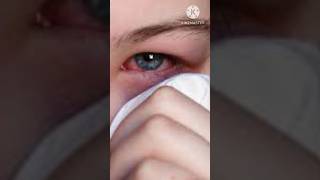 🥕euphrasia 30🙏eye shortsyoutubeshorts [upl. by Latvina]