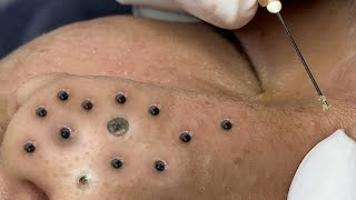 Big Cystic Acne Blackheads Extraction Blackheads amp Milia Whiteheads Removal Pimple Popping  8247 [upl. by Oiliruam293]