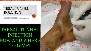 TARSAL TUNNEL INJECTION WHERE AND HOW TO GIVE IT DR HAKAM SINGH [upl. by Lleraj]