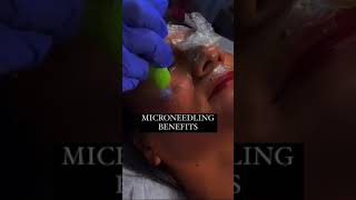 Discover the benefits of microneedling [upl. by Tenney]