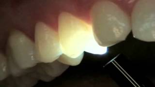 Endodontics Torabinejad 513 Transillumination [upl. by Neeven]