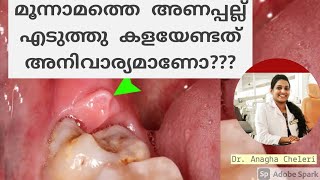 Pericoronitis മൂന്നാമത്തെ അണപ്പല്ല് എടുത്തുകളയേണ്ടത് അനിവാര്യമാണോDr Anaghacheleri [upl. by Amora800]