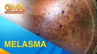 MELASMA Cause and Treatment Explained by Dermatologist [upl. by Madel]