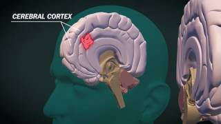 What is glioblastoma [upl. by Leizo224]