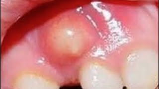 Gum boil causes and treatment [upl. by Aba152]