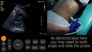 Ultrasound Tutorial Kidney amp Bladder  Urinary Tract  Radiology Nation [upl. by Jelsma995]