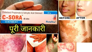 CSORA Ointment uses in hindi  c sora ointment uses in hindi  medisalic ointment  lobate s cream [upl. by Haley]