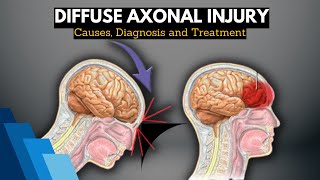 Diffuse Axonal Injury Causes Signs and Symptoms Diagnosis and Treatment [upl. by Notnirb]