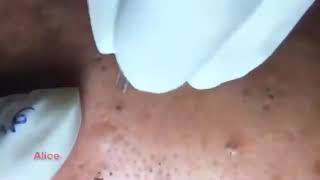 Bloody Blackhead Removal  Brutal pimple popping  deep bloody blackheads [upl. by Cosma]